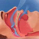 Sleep Apnea